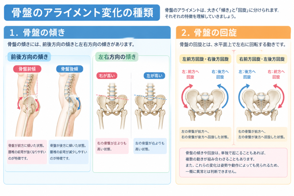 骨盤の前傾・後傾、左右の傾き、回旋の違いを示した医学解説図